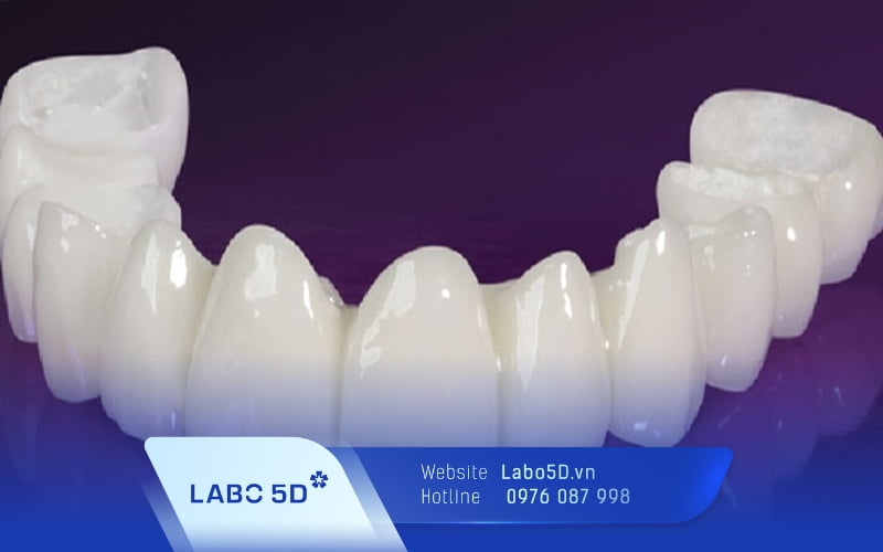 Răng sứ Cercon là gì? Có tốt không? Giá bao nhiêu tiền?
