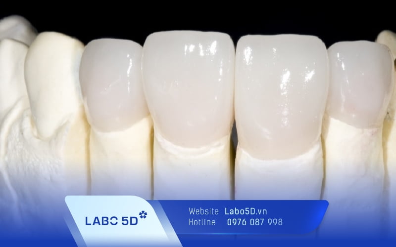 Răng sứ DDBIO – Dòng răng sứ Đức cao cấp đảm bảo chất lượng